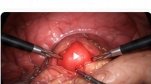 Intraoperative view during laparoscopic gallbladder surgery.
