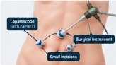 Laparoscopic surgery keyhole incision sites diagram