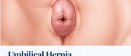 Umbilical Hernia